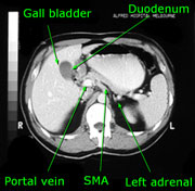 Annotated abdomen CT slice